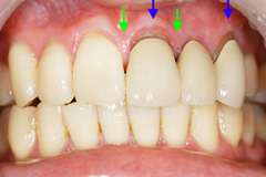 前歯の隙間